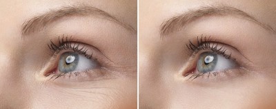 眼部鱼尾纹图解,女生眼部鱼尾纹前后对比