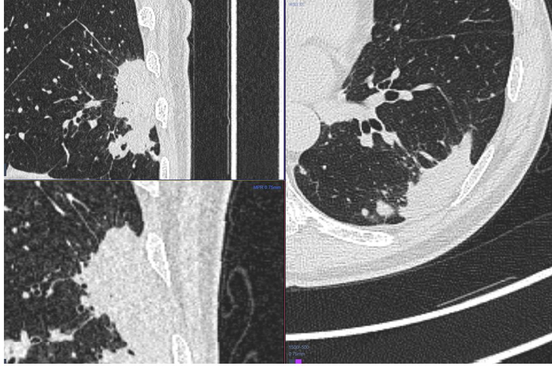 9mm肺结节实性结节良性几率多大,良性肺结节生长速度