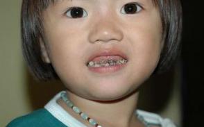 4岁女童牙齿黑的怎么回事,4岁女童牙齿黑