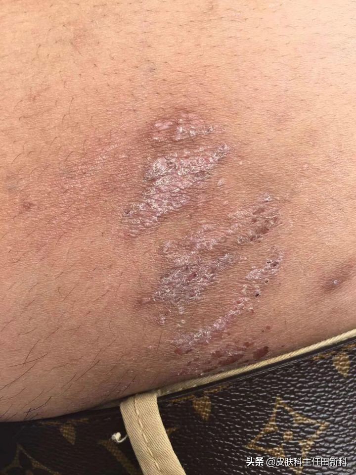 真菌感染性皮肤病原因,人真菌皮肤病怎么治