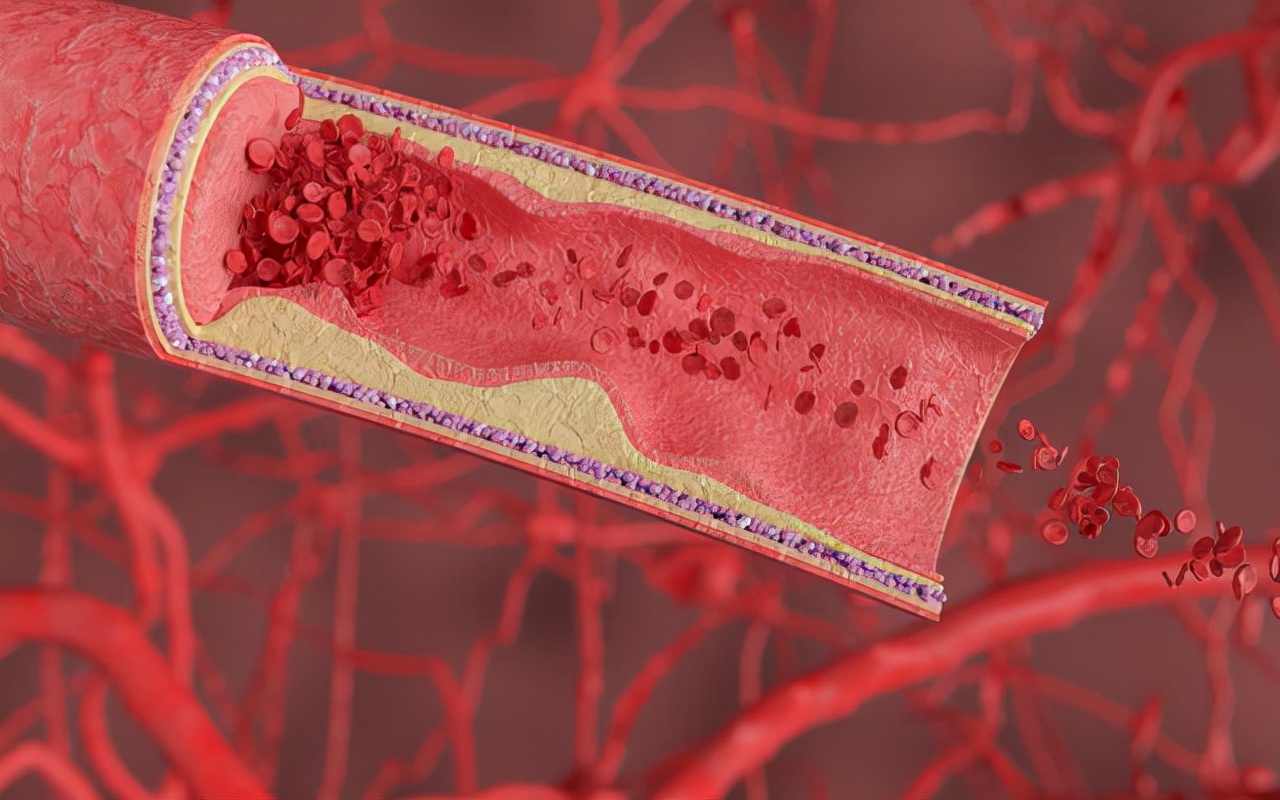 皮下出血紫癜是什么原因造成,皮下出血的意思