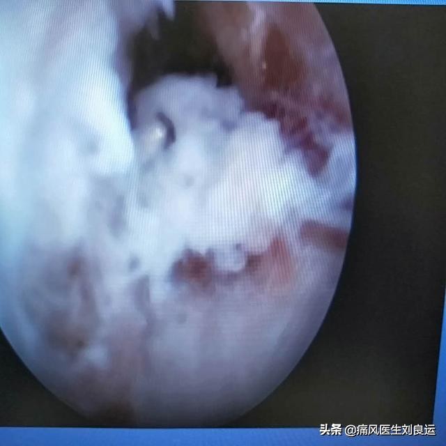 痛风20年长出痛风石，尝试“偏方”险中毒，尿酸高用药有讲究