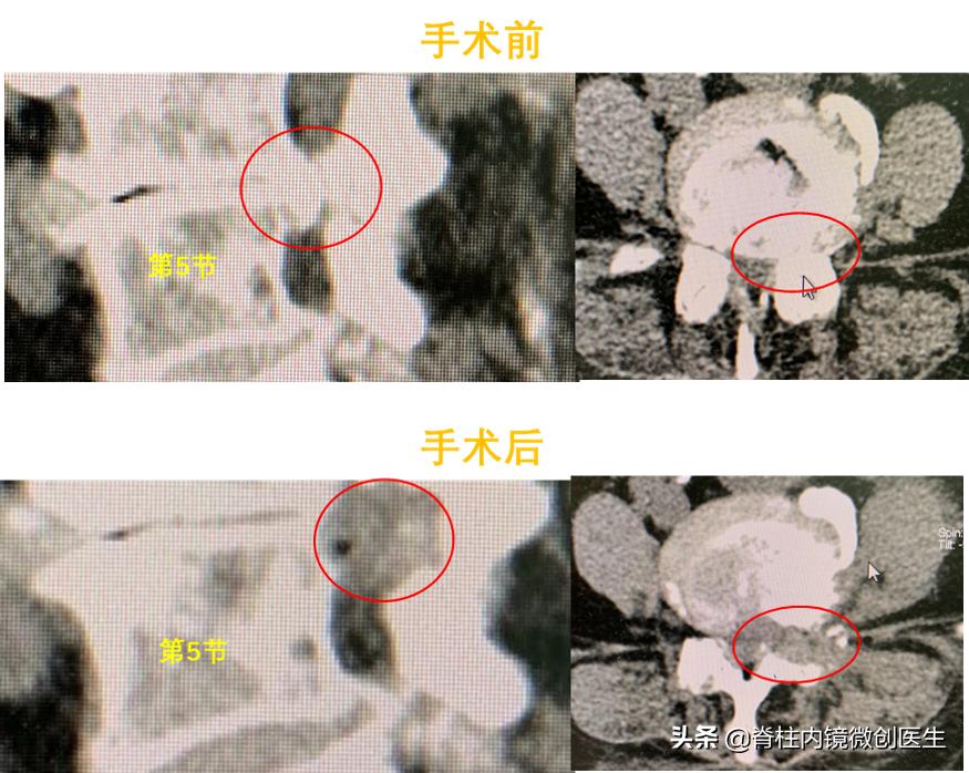 老年腰椎管狭窄的手术治疗,微创手术治疗腰椎管狭窄的技术