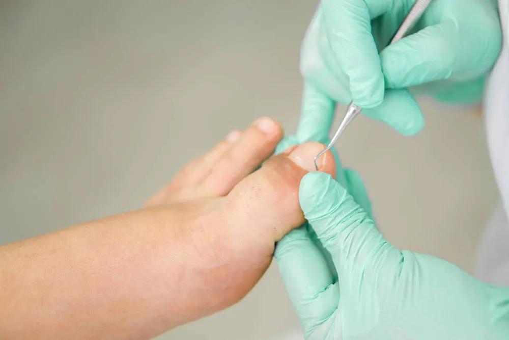 甲沟炎只是撞到墙上痛严重吗,甲沟炎但是不疼有必要弄吗