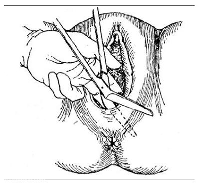 顺产什么情况会被侧切,顺产时候啥情况会引起大出血