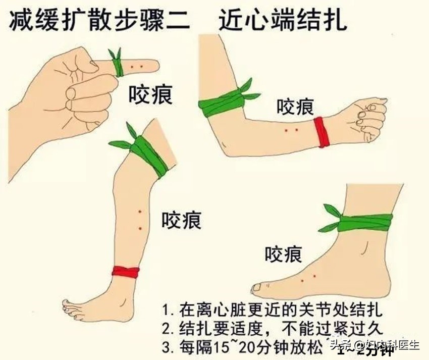 网友被毒蛇咬伤自救,被毒蛇咬伤如何自救原视频