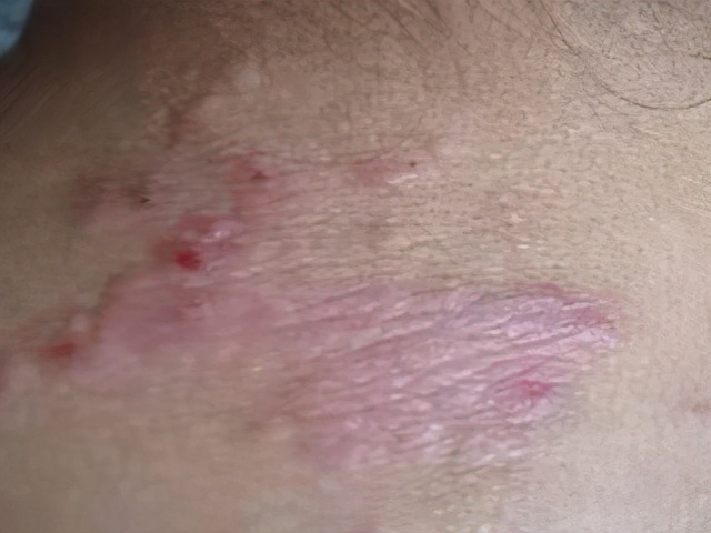 脖子上神经性皮炎的症状图片,只在脖子上起的疹是神经性皮炎吗