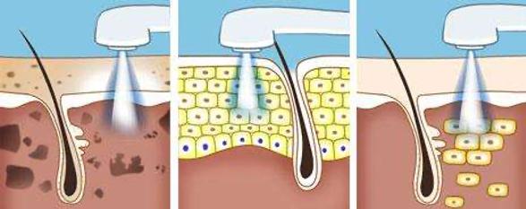 光子嫩肤基础护肤,基础护肤的光子嫩肤