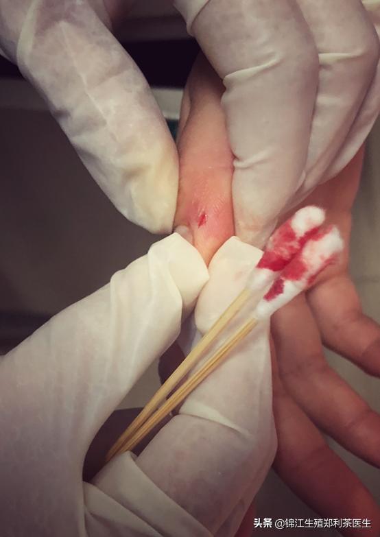 试管移植后上火吃什么降火最快,试管移植后上火怎么治