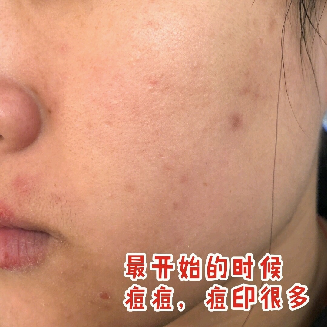 真实有效的几款祛痘印神器,祛痘印最有效的方法排名