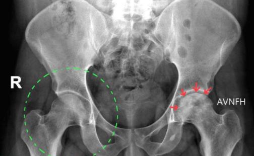 练腹部髂腰肌疼痛怎么恢复,髂腰肌训练时腹股沟疼痛是为什么