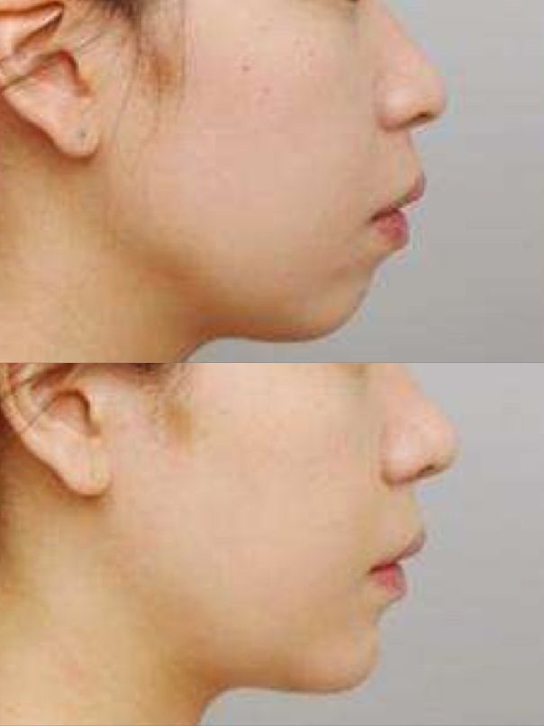 假体垫下巴歪了怎么办,做假体垫下巴后麻是什么原因