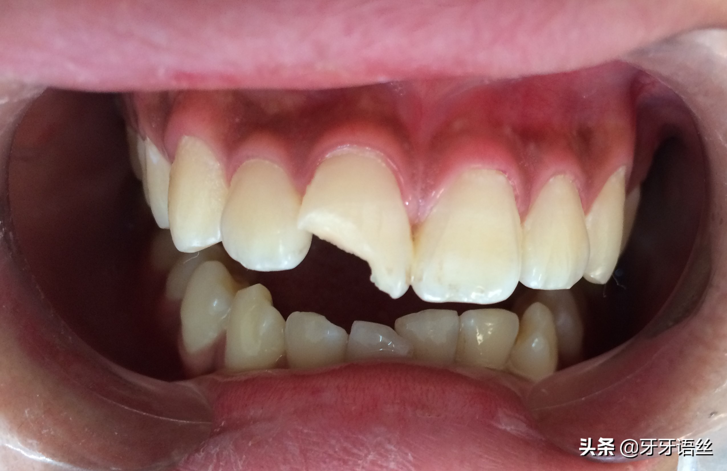 牙断了需要根管治疗吗,儿童牙齿断了剩一点怎么处理