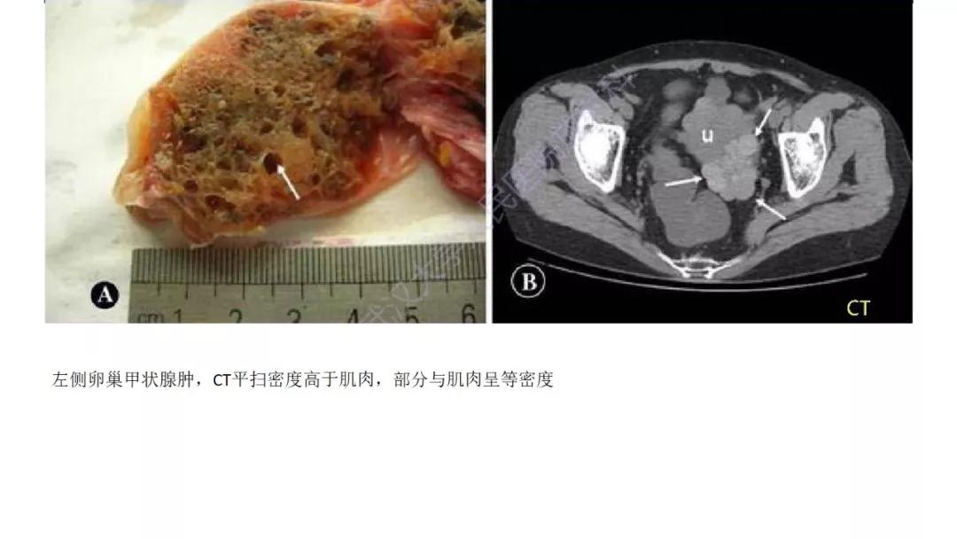卵巢原发肿瘤的分析思路