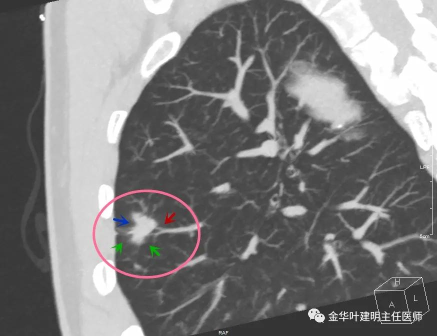 叶建明谈肺结节:一招分辨隐球菌性肉芽肿与肺癌