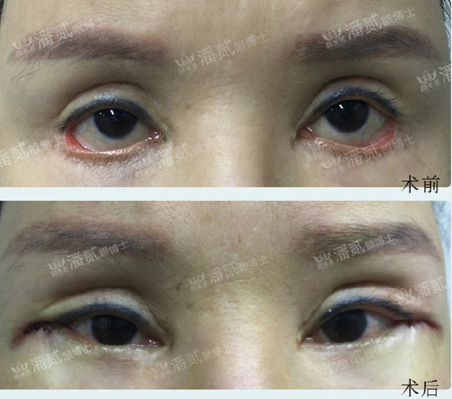 开内眼角失败留疤了怎么办,开外眼角恢复期间会有紧绷感么