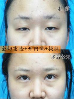 可以只做泪沟不做眼袋吗,上睑下垂矫正不做双眼皮可以吗