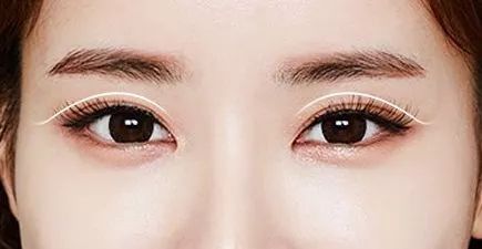 割完双眼皮不忌嘴会怎样,全切双眼皮疤痕增生期是什么时候