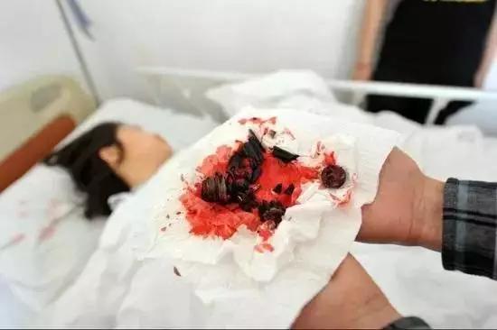 升降椅自爆女子被“*菊爆**”肠道取出多枚碎片!警惕屁股下的椅子