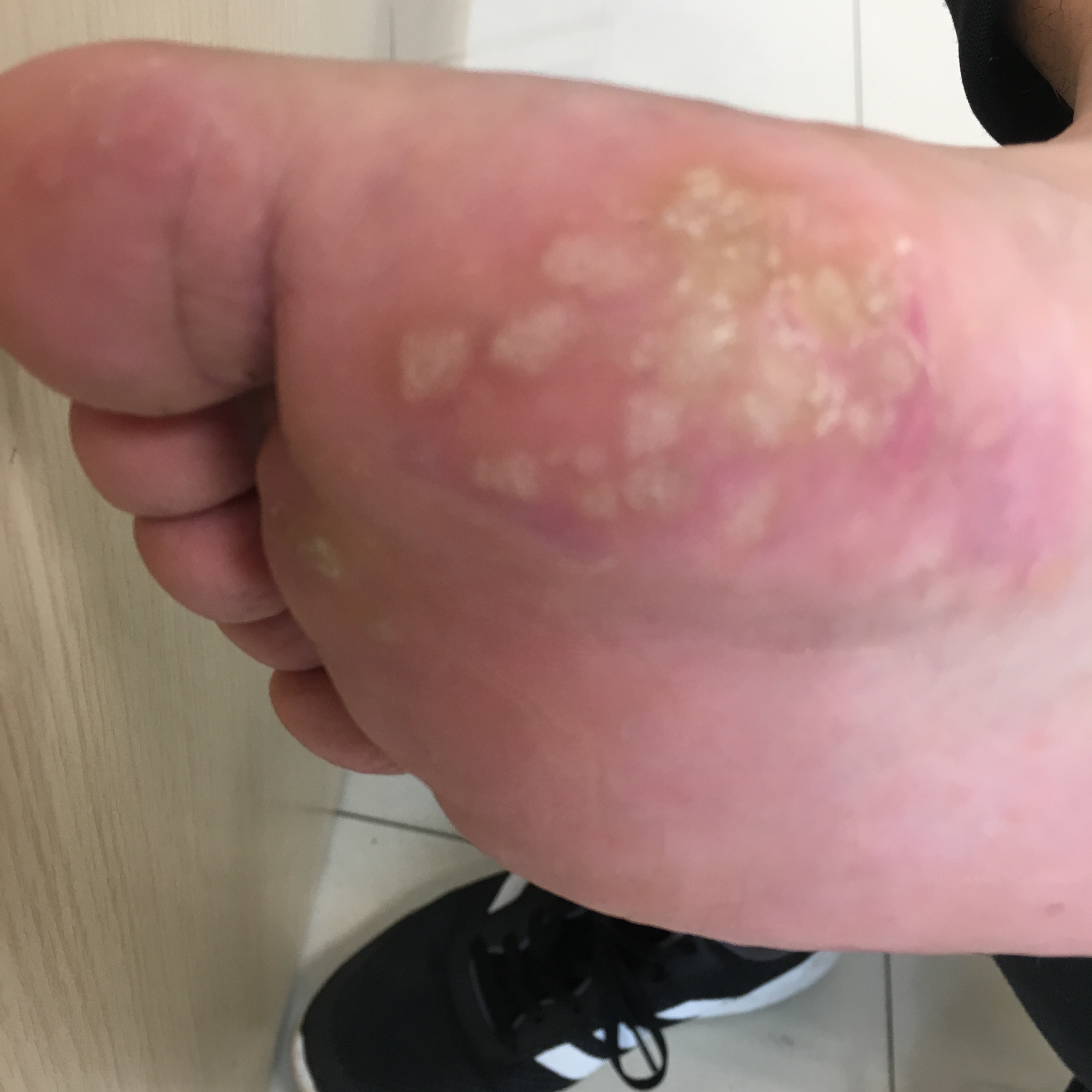 脚上长鸡眼是皮肤病吗,脚上起的是鸡眼还是疣