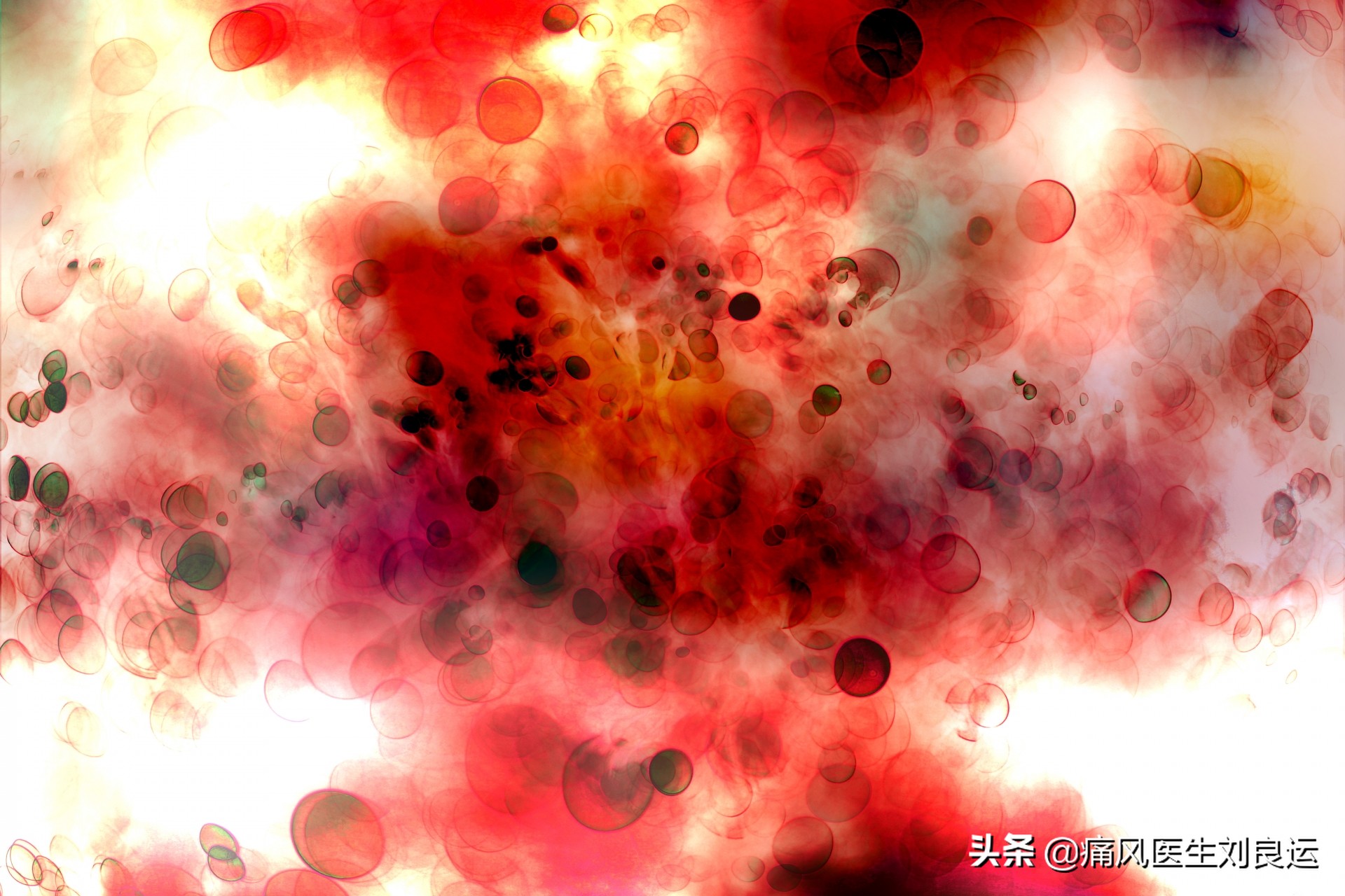 尿酸高除了注意饮食还需要什么,尿酸高有什么办法预防痛风发作