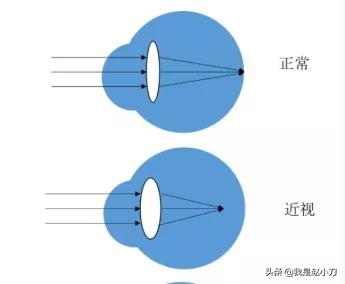 近视和老花可以相互抵消,近视和老花可以相互抵消吗