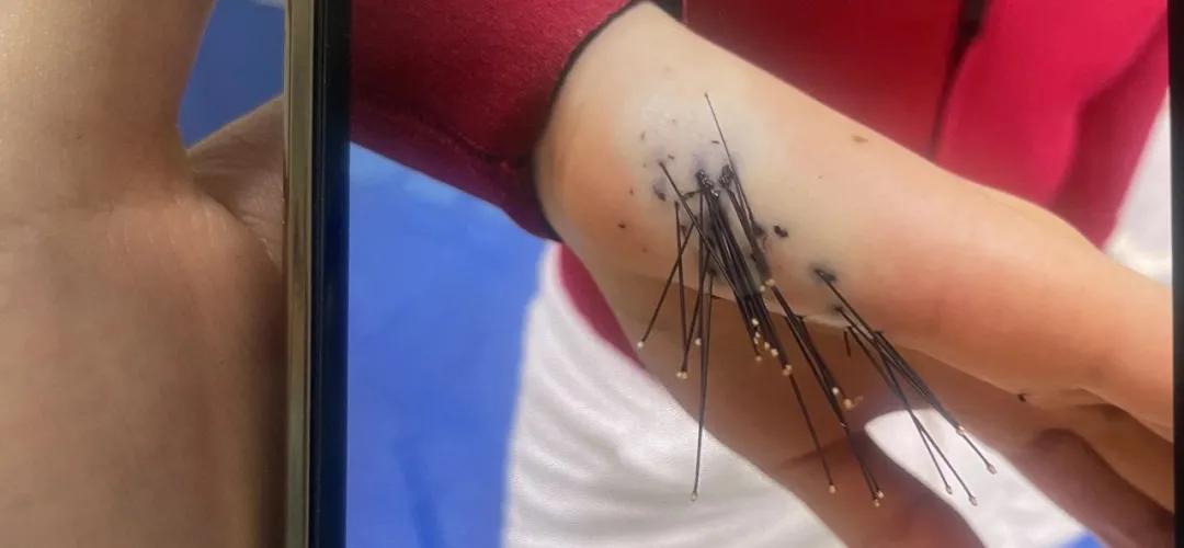 美女潜水时被海胆扎了，差点保不住手！夏季海岛游，专家建议要记牢