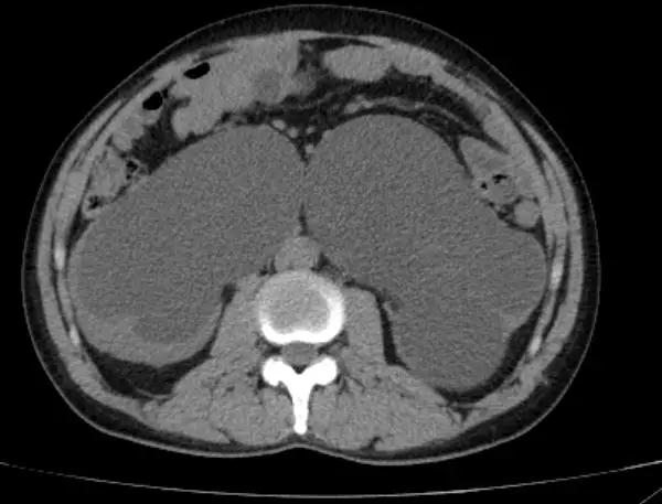 OMG！脂肪长到盆腔里！吓得我赶紧扔掉了手里的鸡腿肉