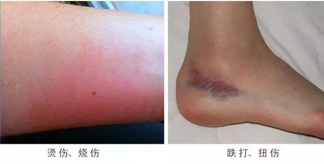 蚊虫叮咬后能用烫伤膏吗,烫伤烧伤瘙痒蚊虫叮咬用什么药膏