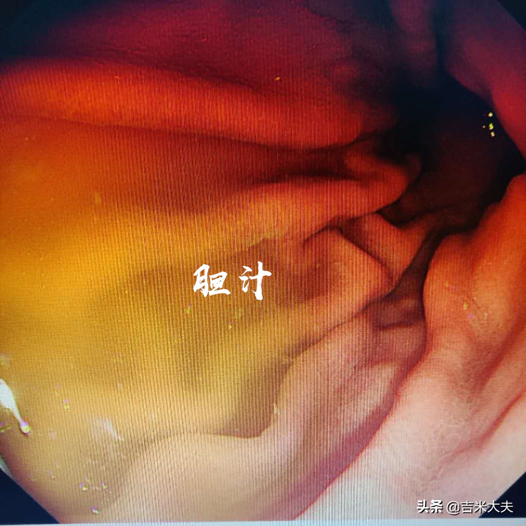 胃镜浅表性胃炎胆汁反流,胃镜胆汁反流性胃炎严重吗