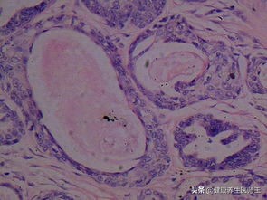 生命缘生殖细胞肿瘤案例,上皮内瘤变是癌变吗