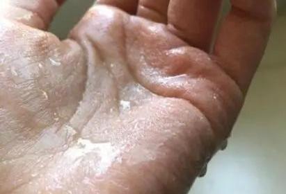 肉毒素可以治疗手心出汗吗,肉毒素治疗手汗症打几针