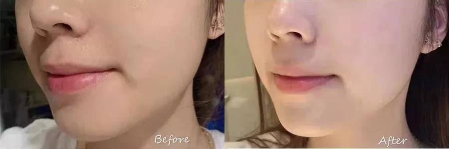 2块钱的它、竟然能亮白、祛痘印、淡斑！？太神奇了！