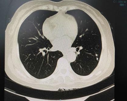 50岁女肺部8毫米结节治疗过程,女士肺结节康复