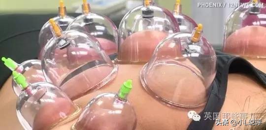 来自东方的神秘力量，让老外痴迷的拔火罐和蚊帐