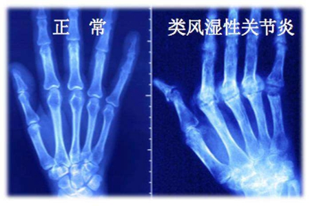 类风湿别瞎折腾,类风湿病病友