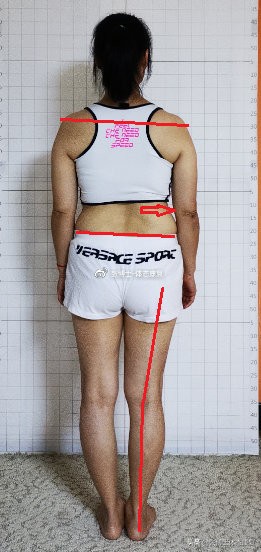 常见腿型矫正,长短腿矫正前矫正后对比