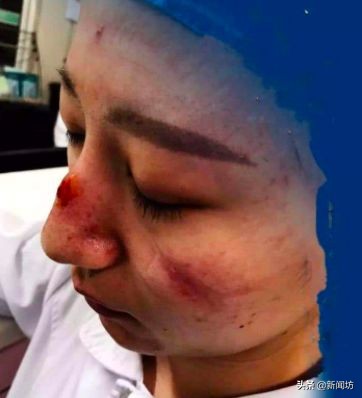 皮肤过敏戴口罩有用吗,用消毒水会有哪些过敏反应