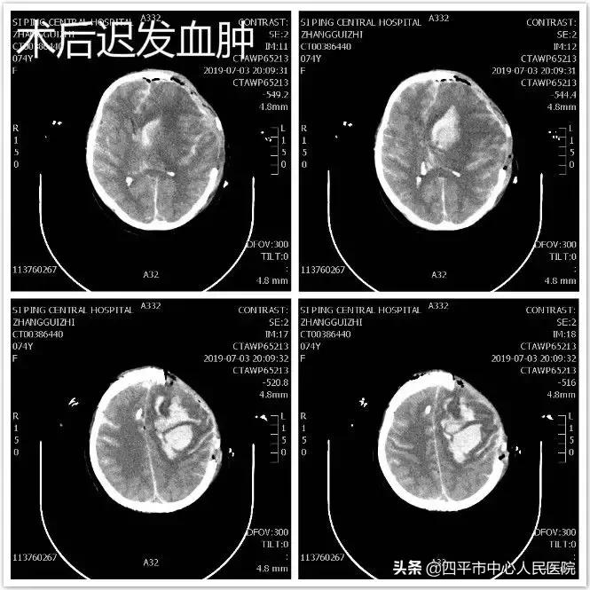 精准排雷再现新高—神经外科在6月份成功救治6例颅内动脉瘤患者