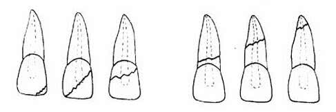 牙齿被牙刷磨出一条缝怎么补,牙齿保持器裂了一条缝能修补吗