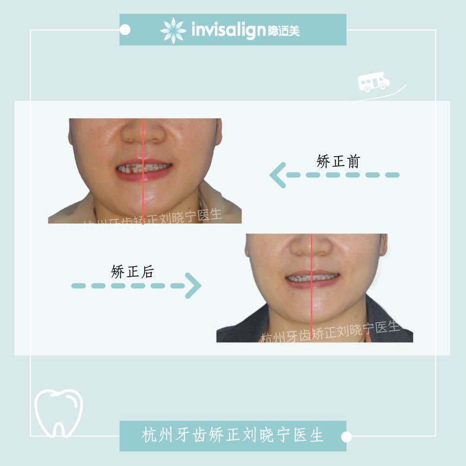 杭州牙齿深覆合矫正,杭州牙齿矫正有什么方法