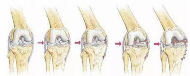 膝关节的22种常见病治疗,膝关节疼痛的相关知识