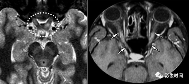 脊髓病变案例图文问诊,脊髓病变视频
