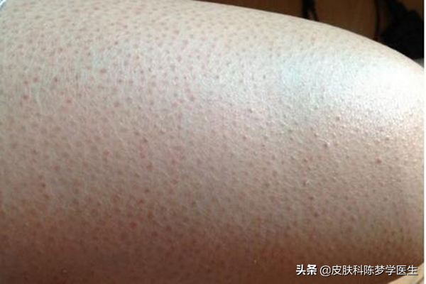 市面上的维a酸乳膏有效果吗,火爆全网的维a酸乳膏