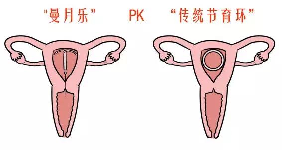 曼月乐避孕环多久有避孕效果,曼月乐避孕环是怎么避孕