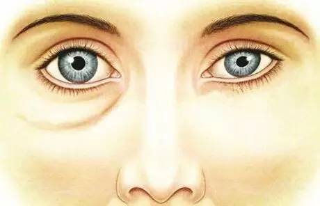 眼袋重显老去眼袋的方法,眼袋很重怎么治