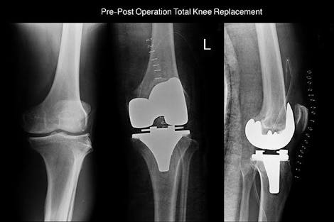 关节炎辟谣,膝关节滑膜炎辟谣