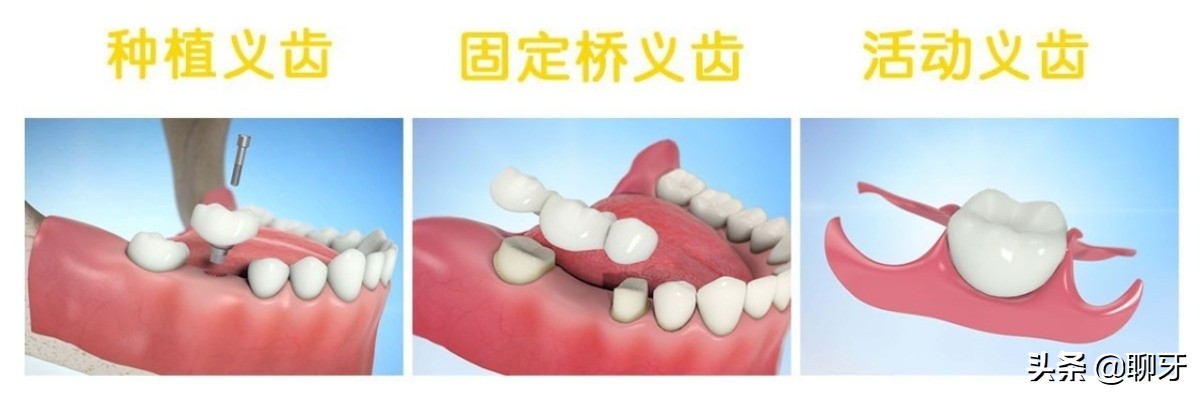牙齿需要种植牙会经历几个步骤,种植牙流程什么情况需要做骨粉