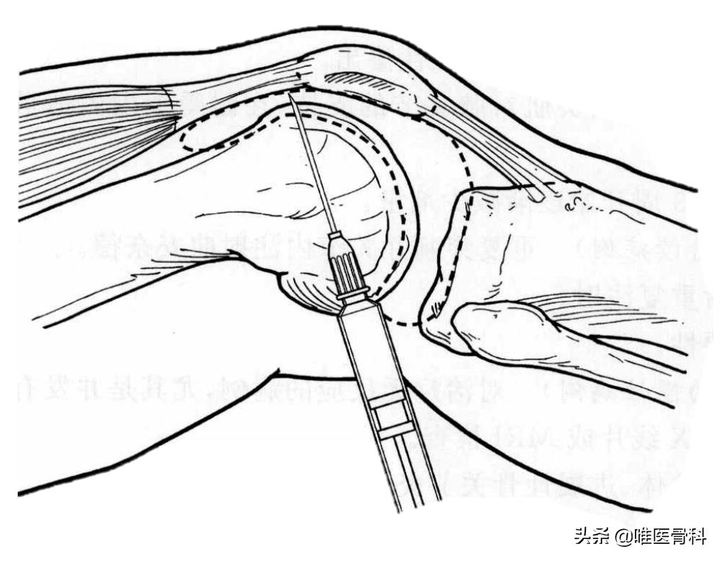 关节炎打玻璃酸钠作为“润滑针”，到底有没有用？