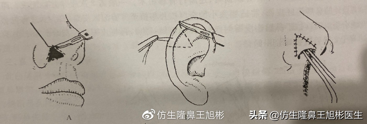 鼻翼缘退缩要如何矫正|王旭彬隆鼻